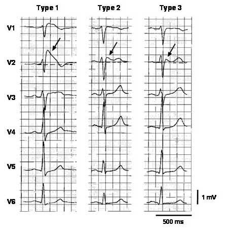 Три типа поднятия сегмента ST при синдроме Бругада, как показано в грудных отведениях на ЭКГ у одного и того же больного в разное время. На левом фрагменте показан образец ЭКГ 1 типа с ярко выраженным подъемом J-точки (стрелка), сегмент ST по типу «свод» и инвертированная T-волна в отведениях V1 и V2. Средний фрагмент иллюстрирует образец 2 типа с сегментом ST по «седловидному» типу, увеличенным на> 1 мм. На правом фрагменте показан образец 3 типа, при котором сегмент ST повышен, 1 мм., модель ЭКГ типа 1 является средством диагностики синдрома Бругада.